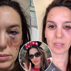 Former Disney star Christy Carlson Romano reveals shocking details about nearly losing her eye after being shot in face