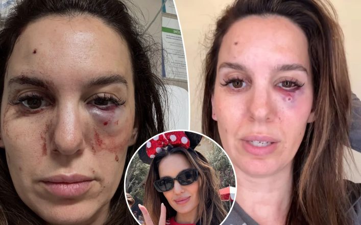 Former Disney star Christy Carlson Romano reveals shocking details about nearly losing her eye after being shot in face