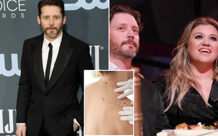 What to know about dangerous ‘black tumor’ cancer as Kelly Clarkson’s ex-husband Brandon Blackstock dies at 48