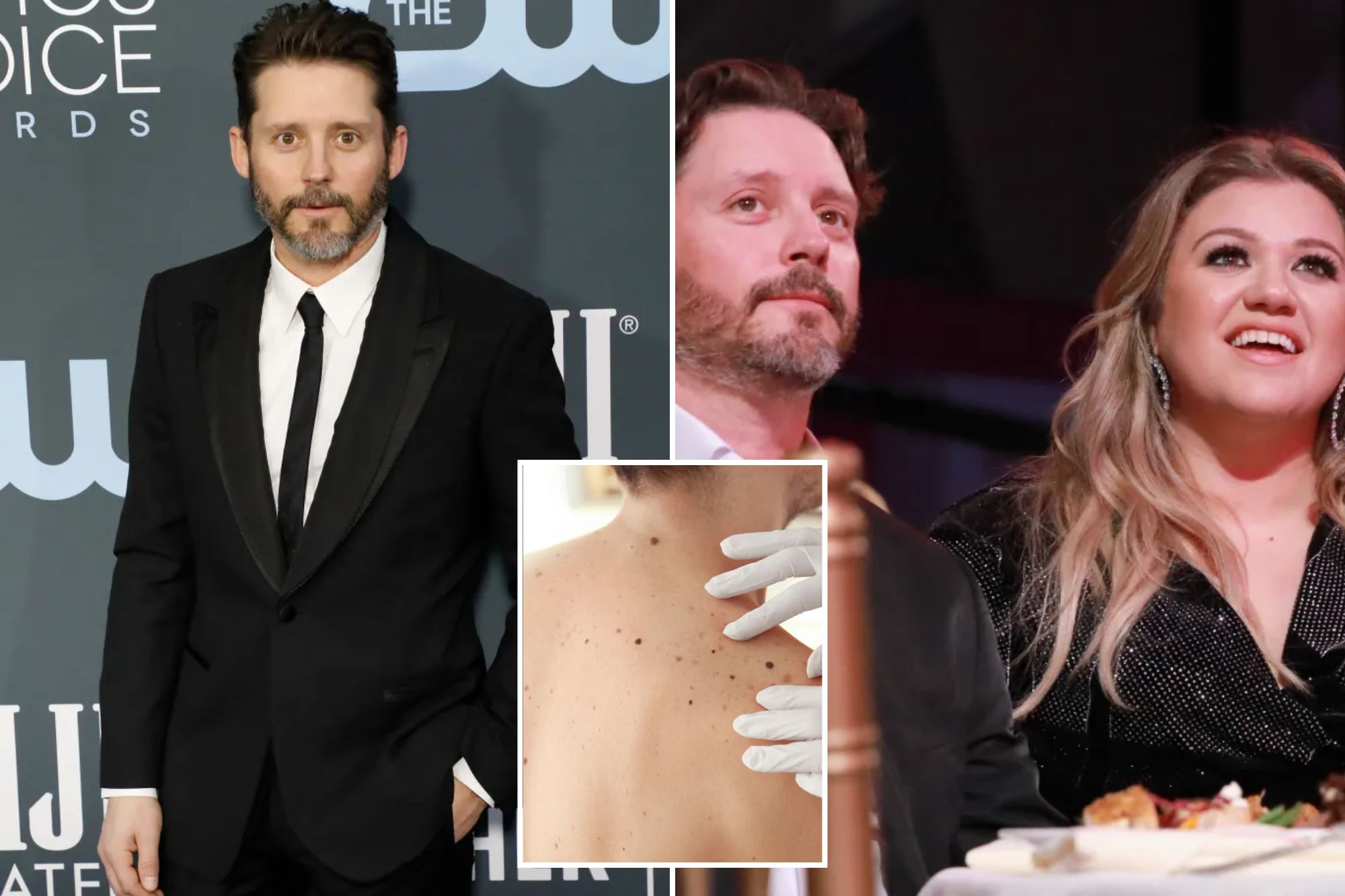What to know about dangerous ‘black tumor’ cancer as Kelly Clarkson’s ex-husband Brandon Blackstock dies at 48